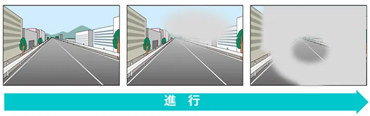 視野障害の進行イメージ